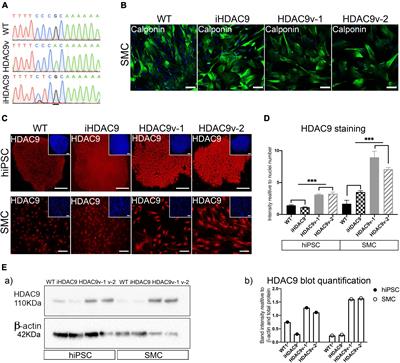 The Histone Deacetylase 9 Stroke-Risk Variant Promotes Apoptosis and Inflammation in a Human iPSC-Derived Smooth Muscle Cells Model